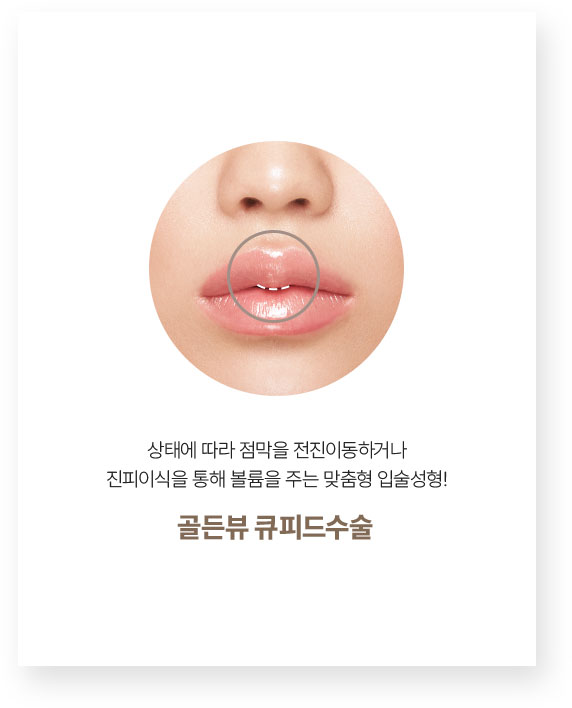 입꼬리수술잘하는곳,입술성형외과,입술확대,윗입술성형,입술성형비용,남자입술성형,외측인중축소,입술확대술,입성형,입술비대칭수술,인중오목,입술비대칭,인중길이,입술교정