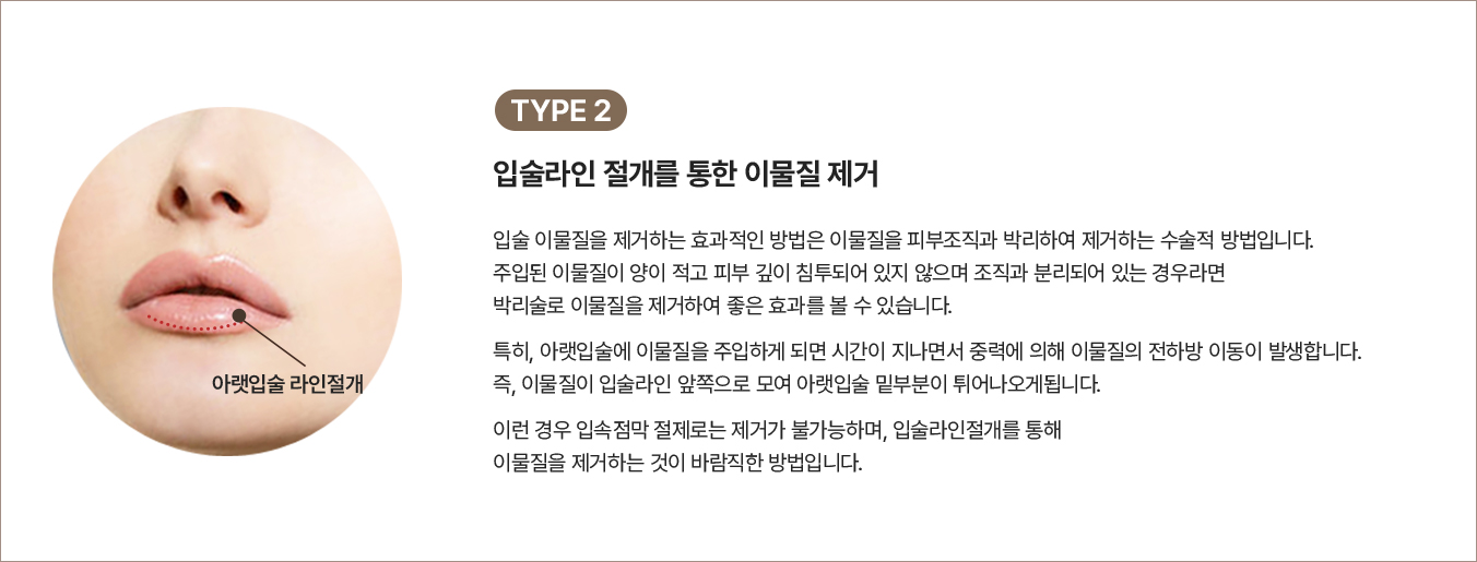 얼굴흉터,입꼬리보톡스,부산인중축소,입술성형잘하는곳,필러성형외과,일자주름,입술필러추천,입술흉터치료,인중길이,입꼬리성형가격,입술확대술,입술비대칭수술,인중오목