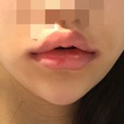 입성형,입술주름,입술라인,입꼬리리프팅,입술꼬리,벨라필,비순각수술