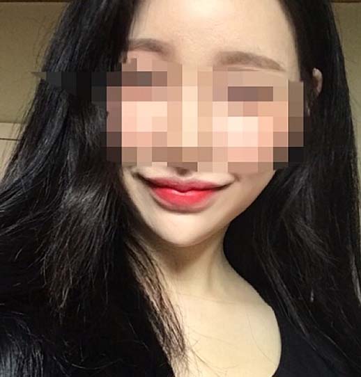 입꼬리비대칭,입꼬리수술비용,입꼬리교정,입꼬리수술잘하는곳,입술성형외과,입술확대,윗입술성형,입술성형비용,남자입술성형,외측인중축소