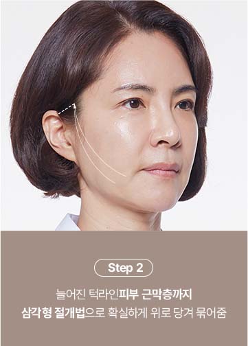 안면거상술잘하는곳,눈썹거상술,미니거상잘하는곳,스마스안면거상,스마일거상,미니안면거상술,턱선리프팅,50대안면거상,최소절개안면거상