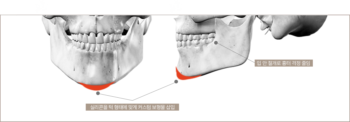 윗입술축소,인중리프팅,인중골성형,인중골수술,두꺼운입술성형,입술성형잘하는곳,명동입술필러,흉터제거수술,흉터치료,입술필러후기,흉터레이저,흉터제거,수술흉터제거