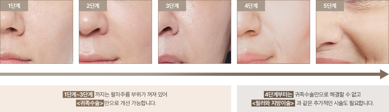 팔자주름치료법