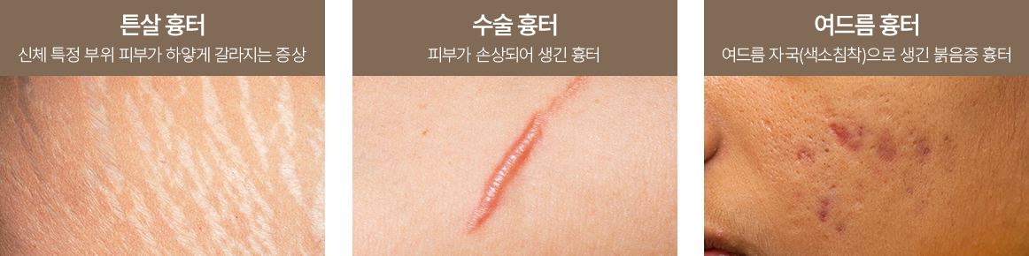 골든뷰 리제네라 흉터셀